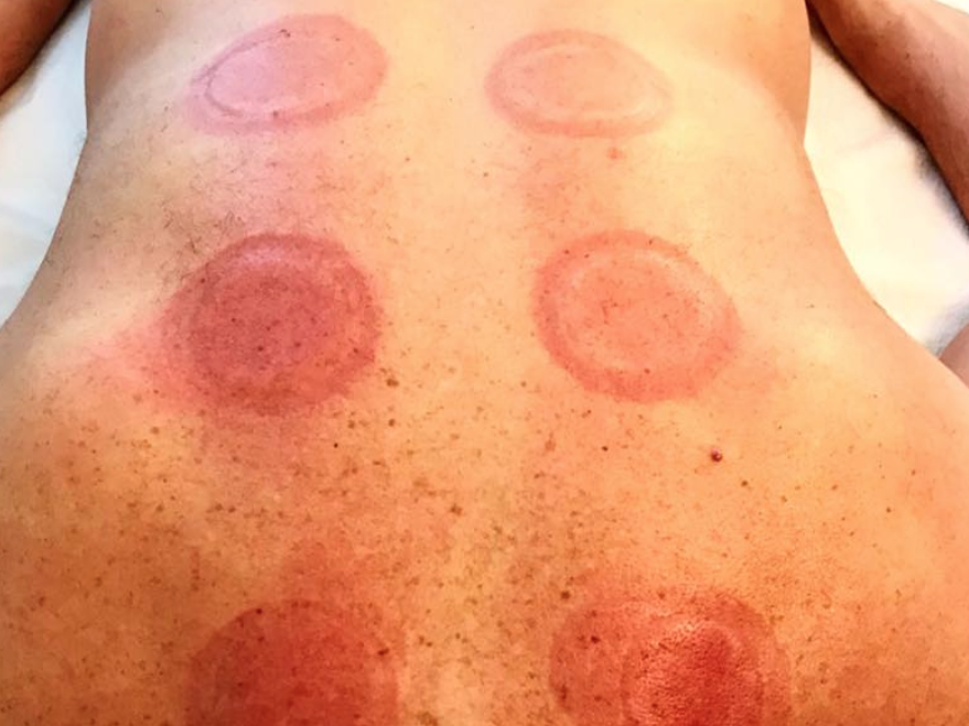 Fire cupping is not all about the purple marks